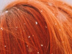 Dandruff