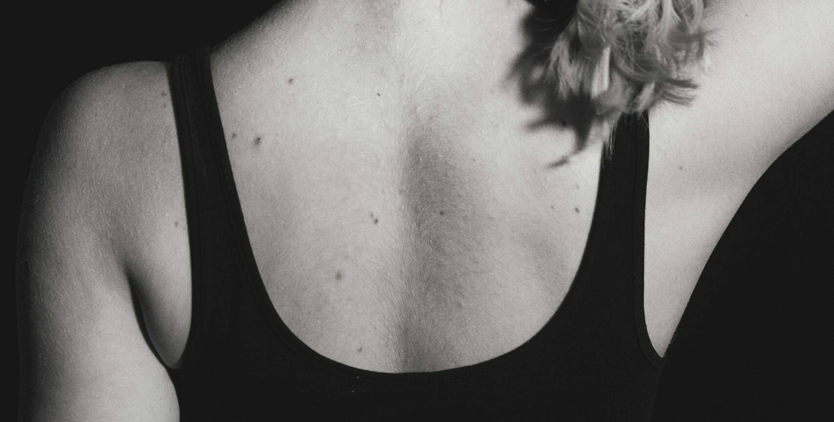 Cherry angiomas