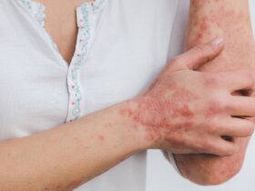 Psoriasis: The Best Diet To Reduce The Flare-Ups