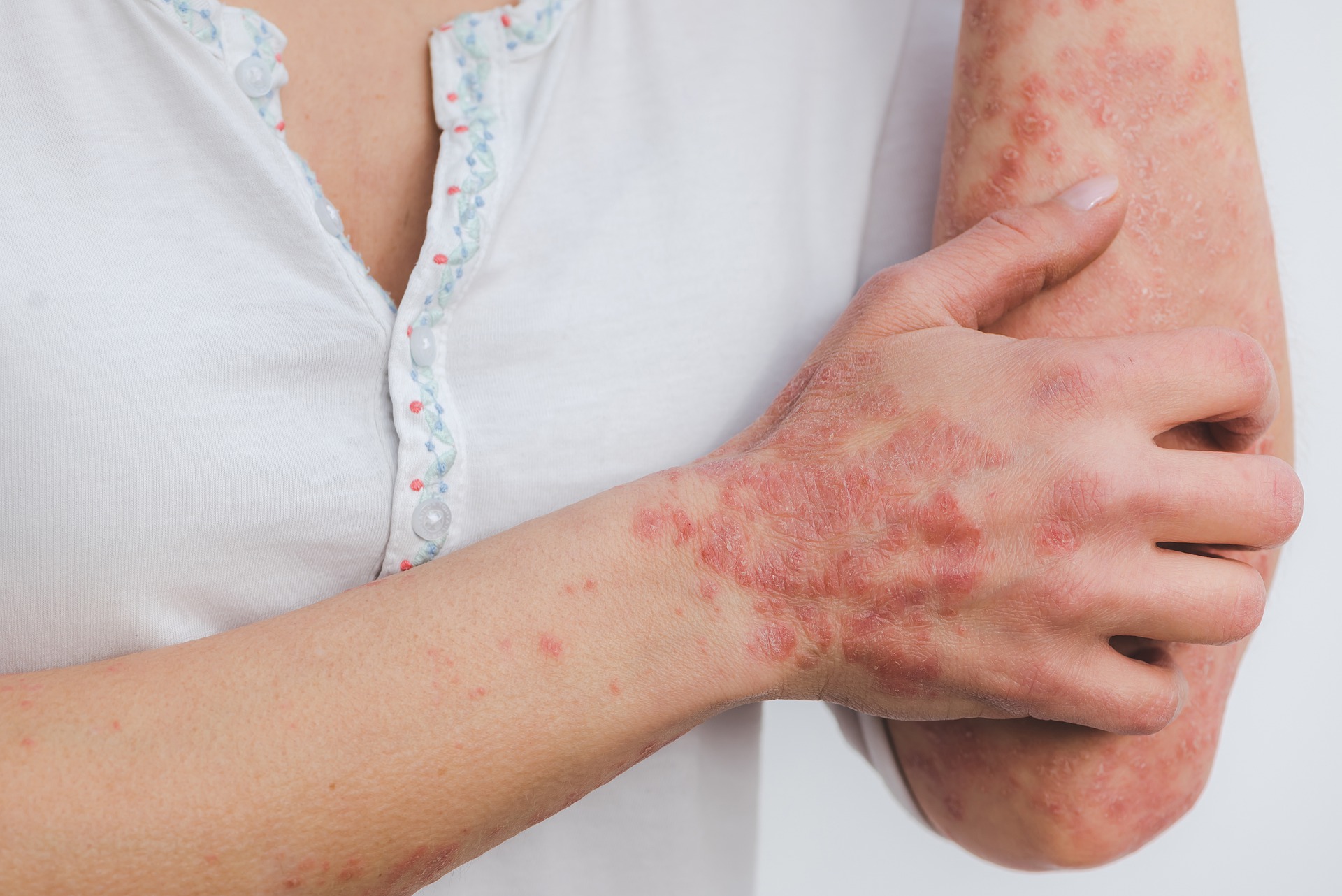 Psoriasis: The Best Diet To Reduce The Flare-Ups