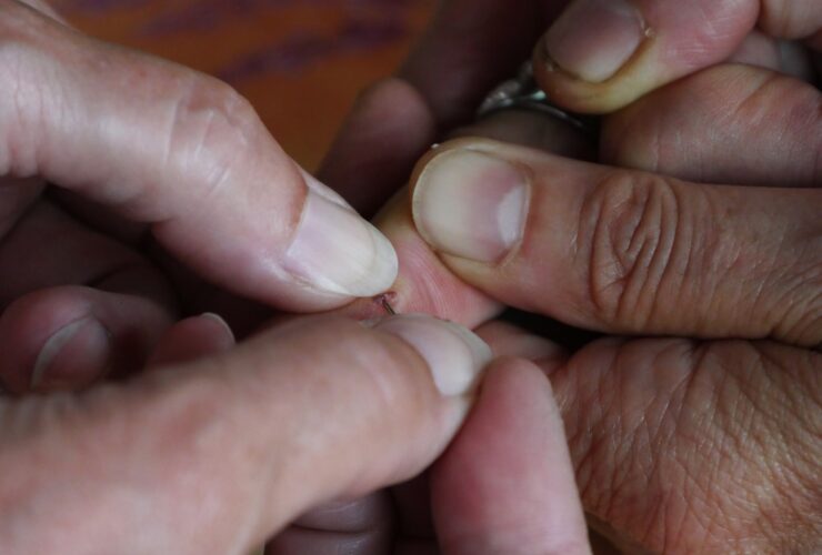 How to safely remove splinters
