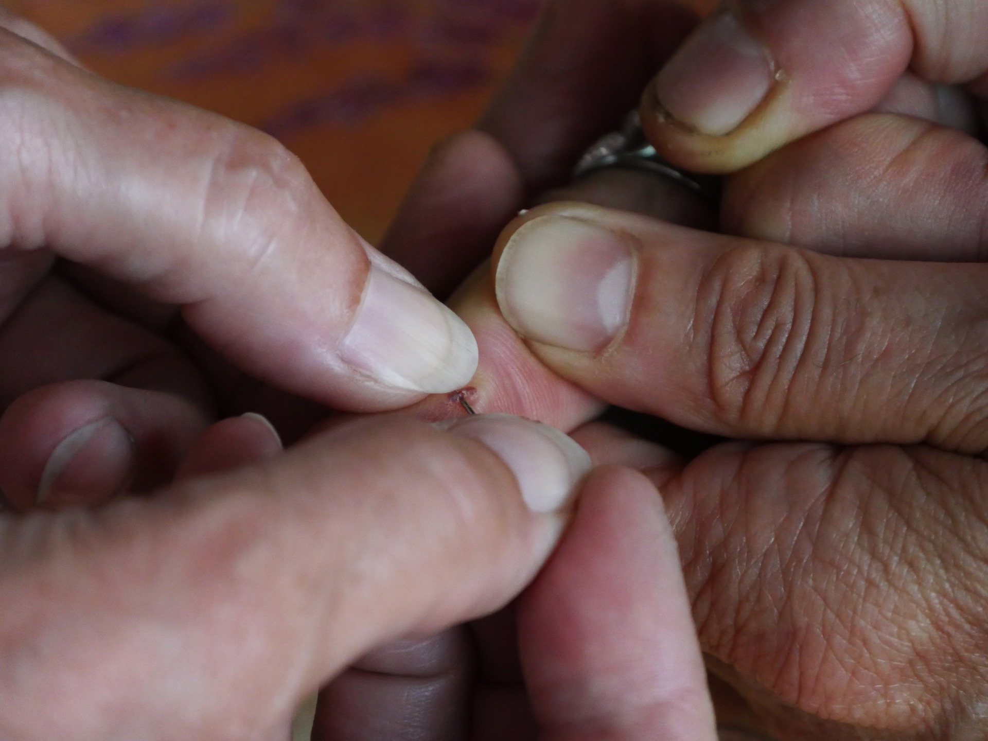 How to safely remove splinters